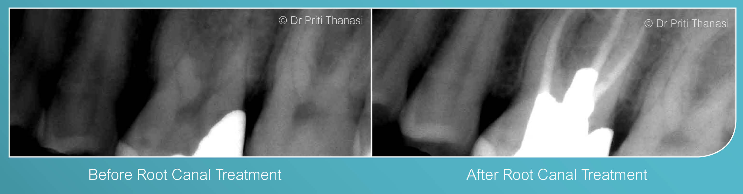 Before and after root canal treatment example 2